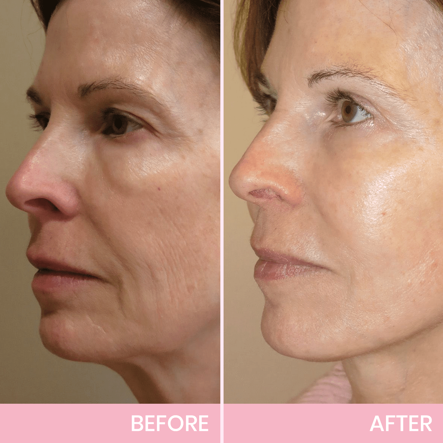 Invisible Face Lift Tape Patches