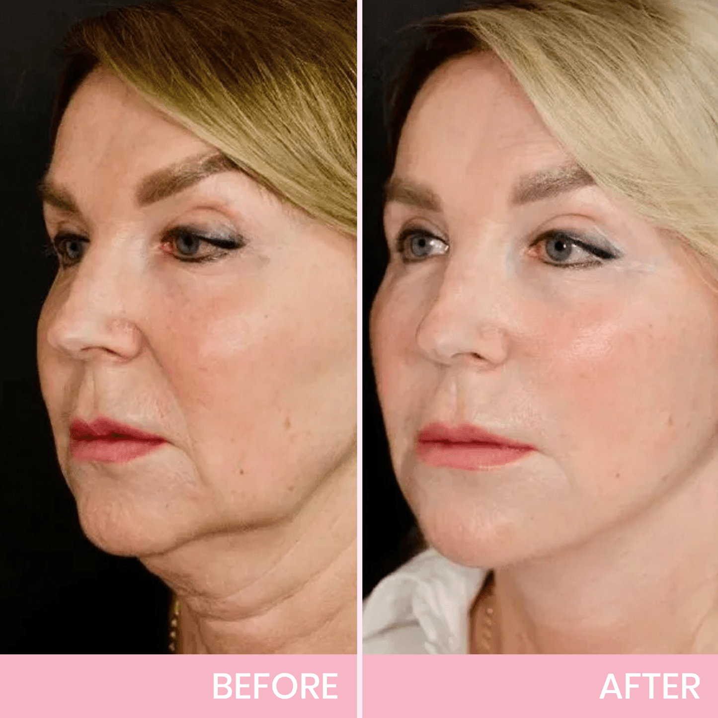 Invisible Face Lift Tape Patches