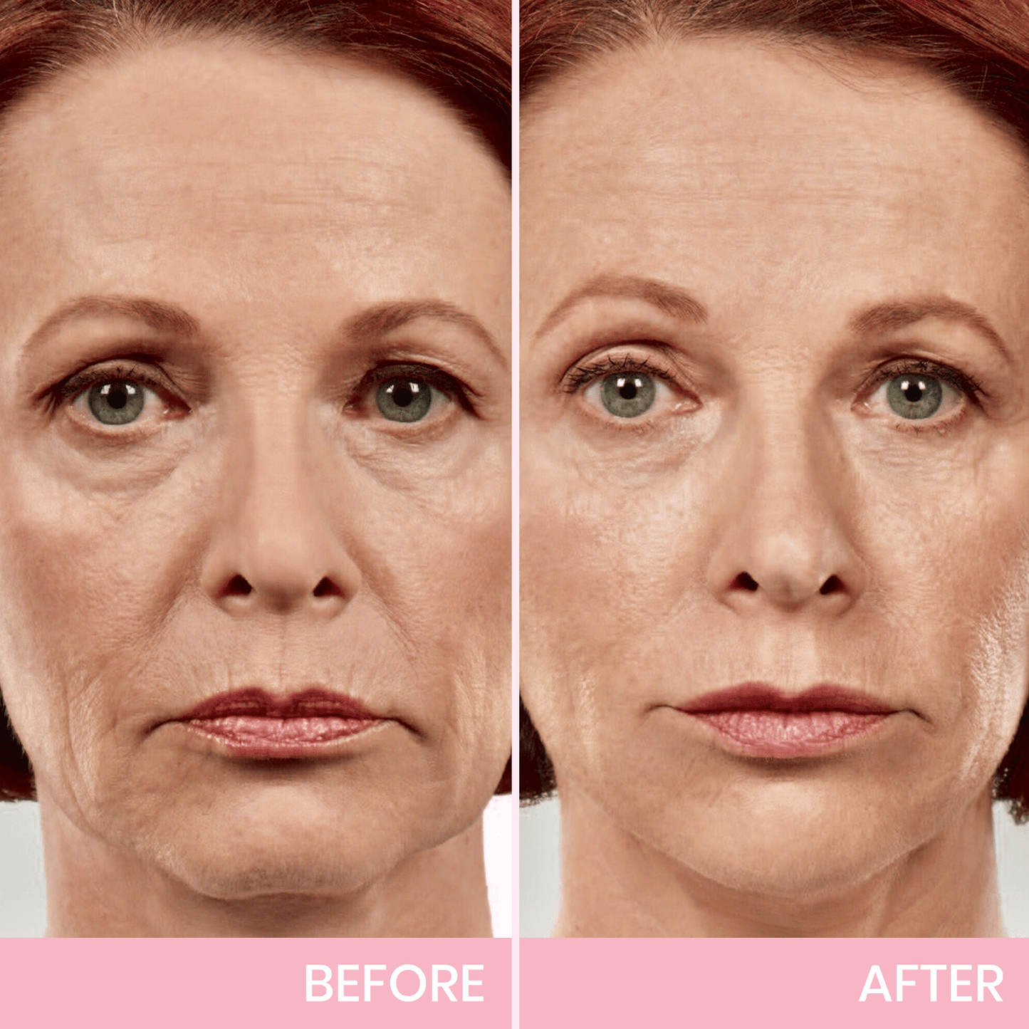 Invisible Face Lift Tape Patches