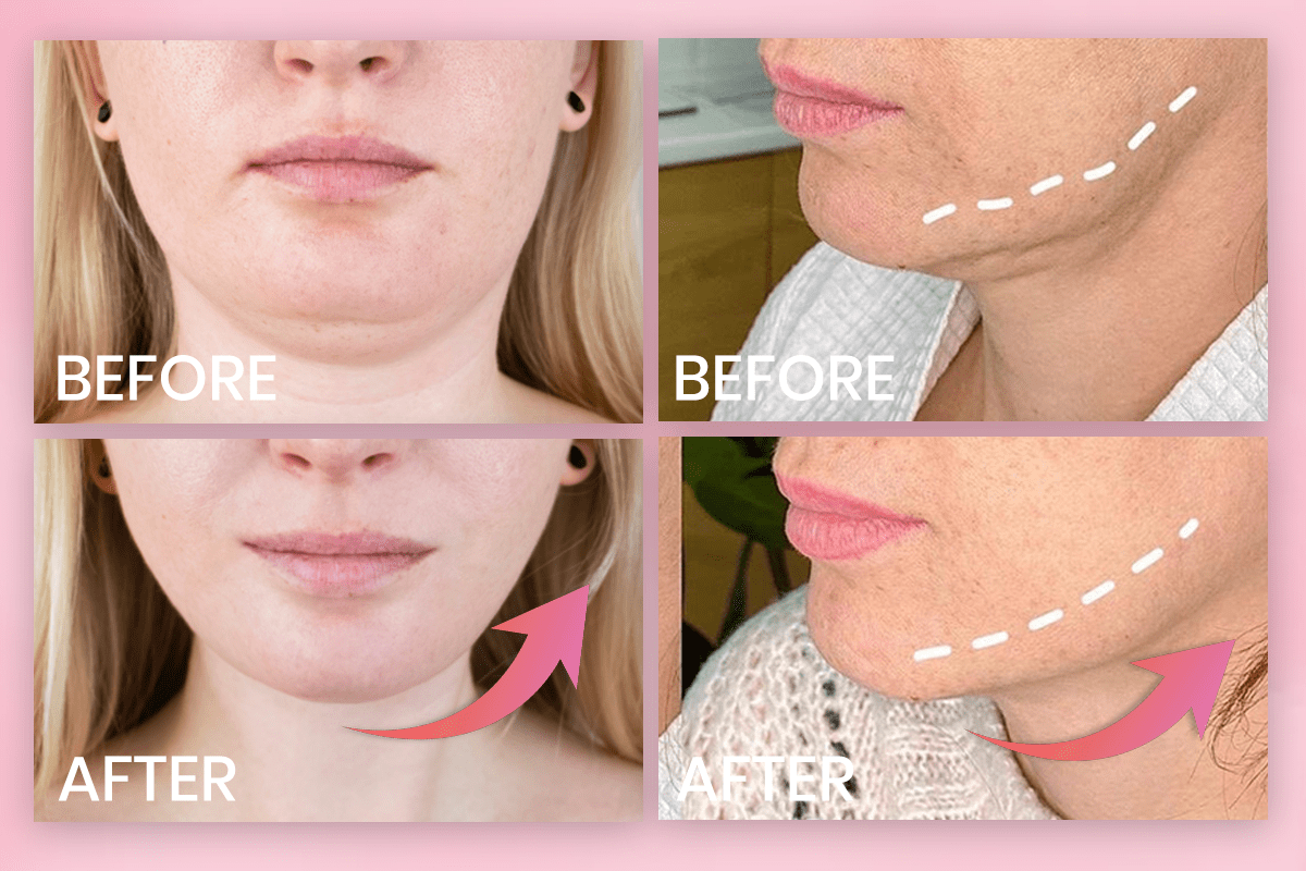 Invisible Face Lift Tape Patches